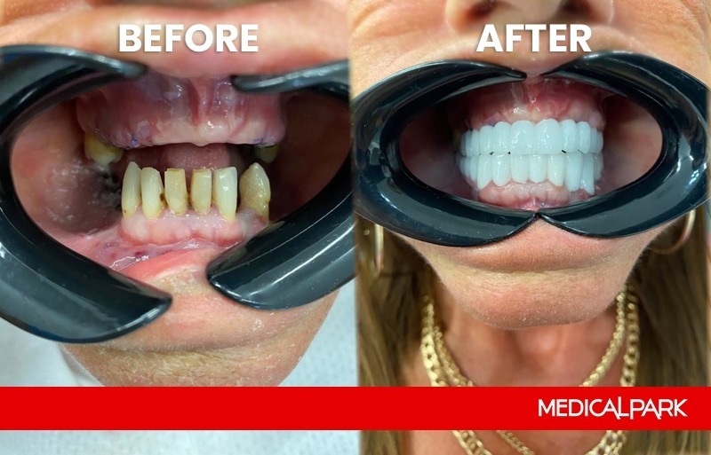 Stomatologia estetyczna, Hollywood Smile — uśmiech przed i po