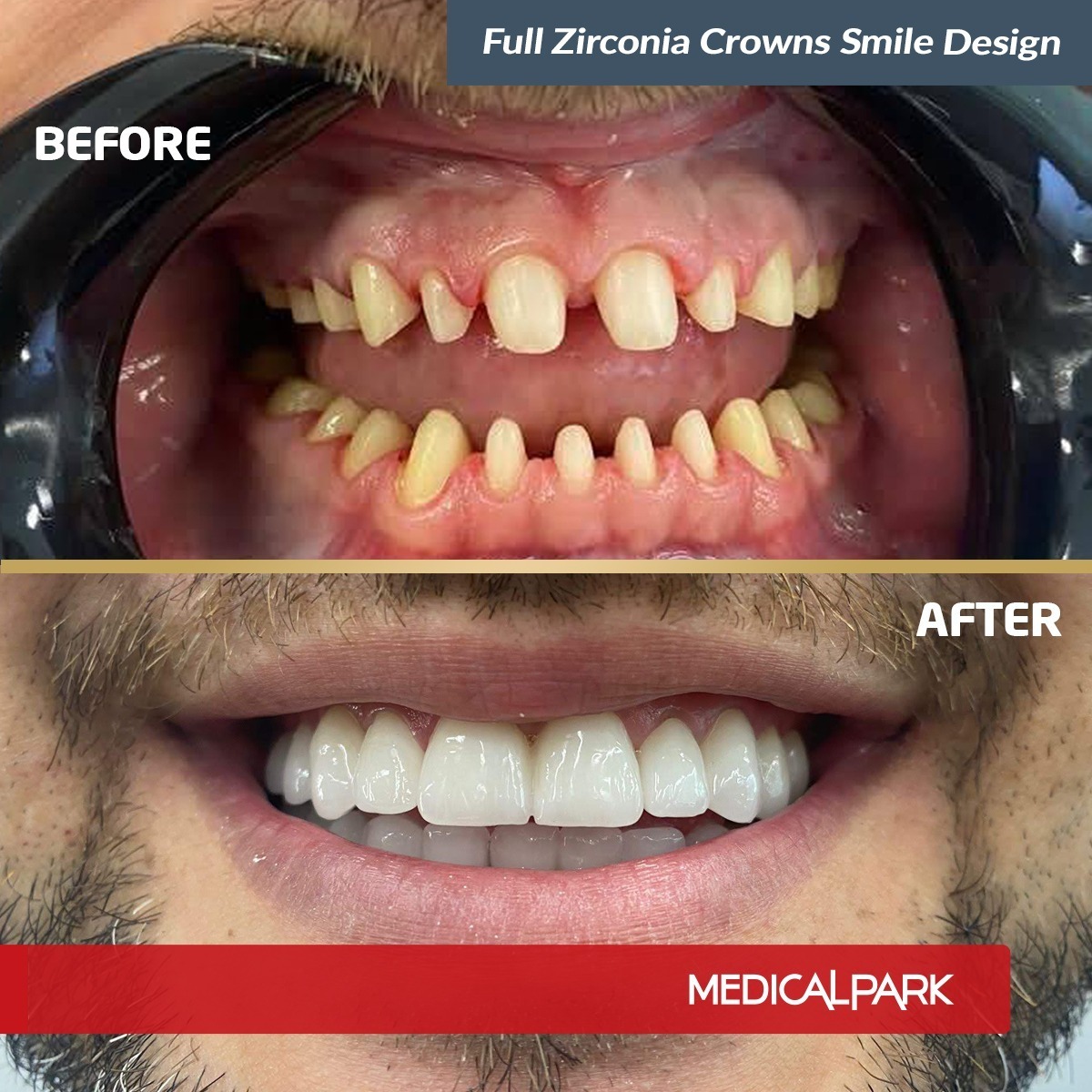 Stomatologia estetyczna, Hollywood Smile — uśmiech przed i po