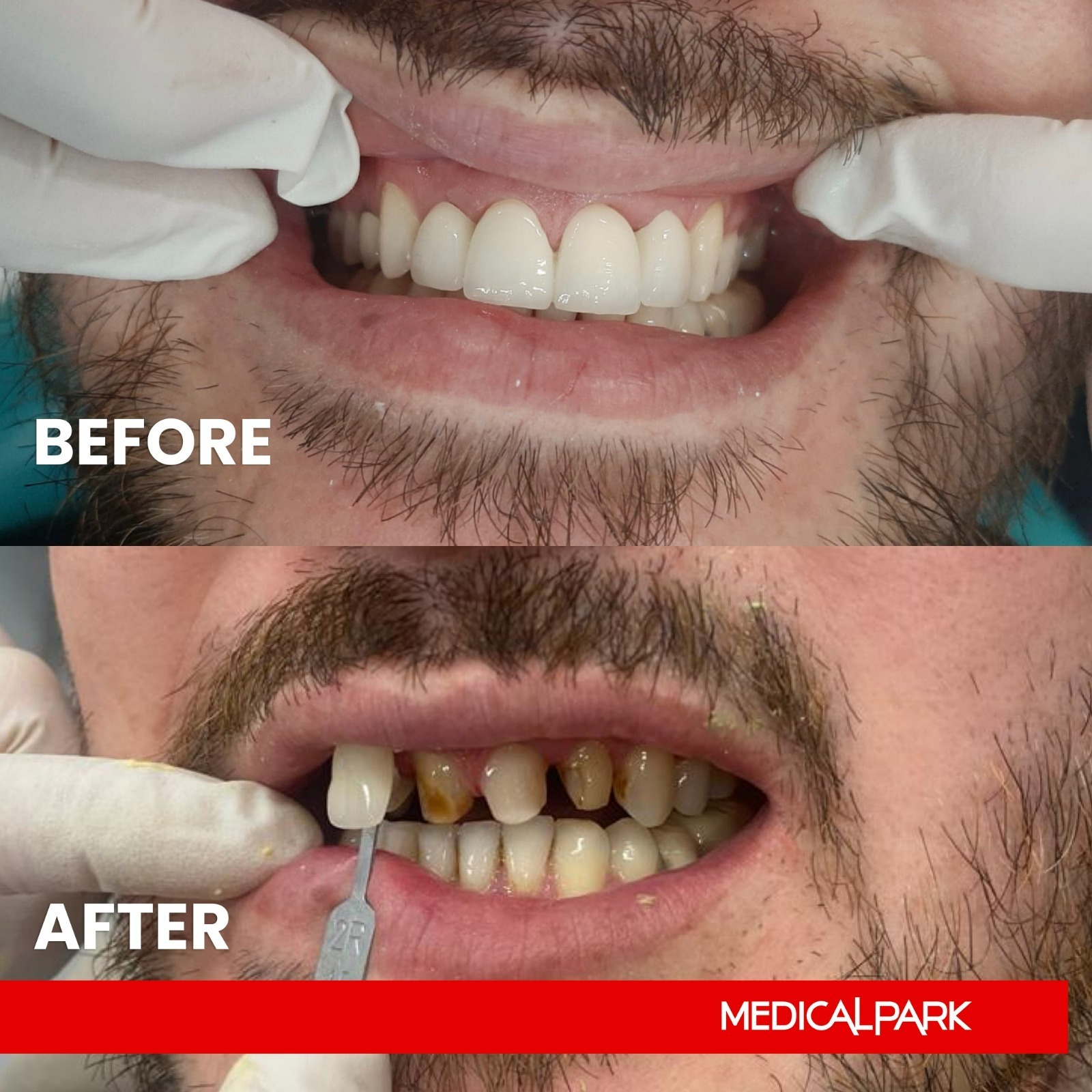 Stomatologia estetyczna, Hollywood Smile — uśmiech przed i po