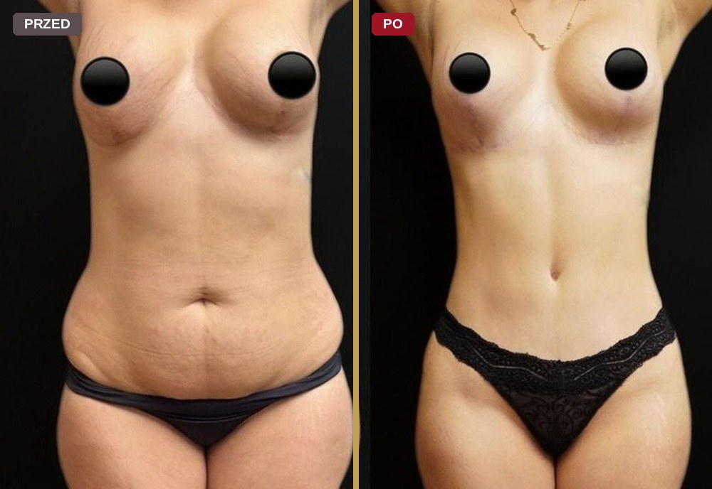 Modelowanie piersi, zdjęcia przed i po zabiegu
