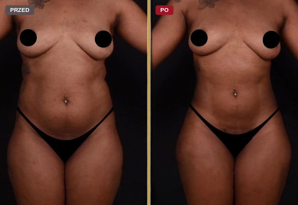 Liposukcja i modelowanie sylwetki, zdjęcia przed i po zabiegu