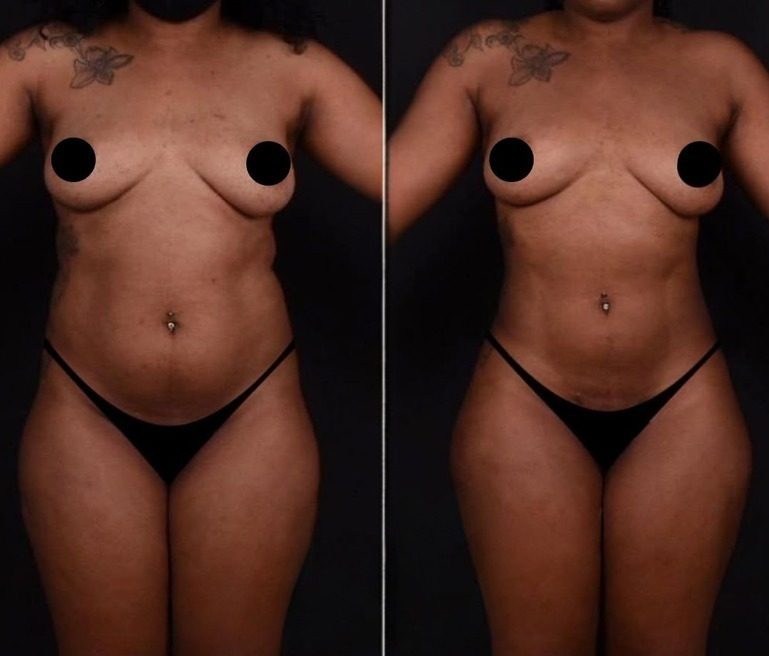 Modelowanie piersi, porównanie przed i po zabiegu