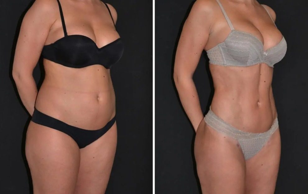 Liposukcja i modelowanie sylwetki, efekt przed i po
