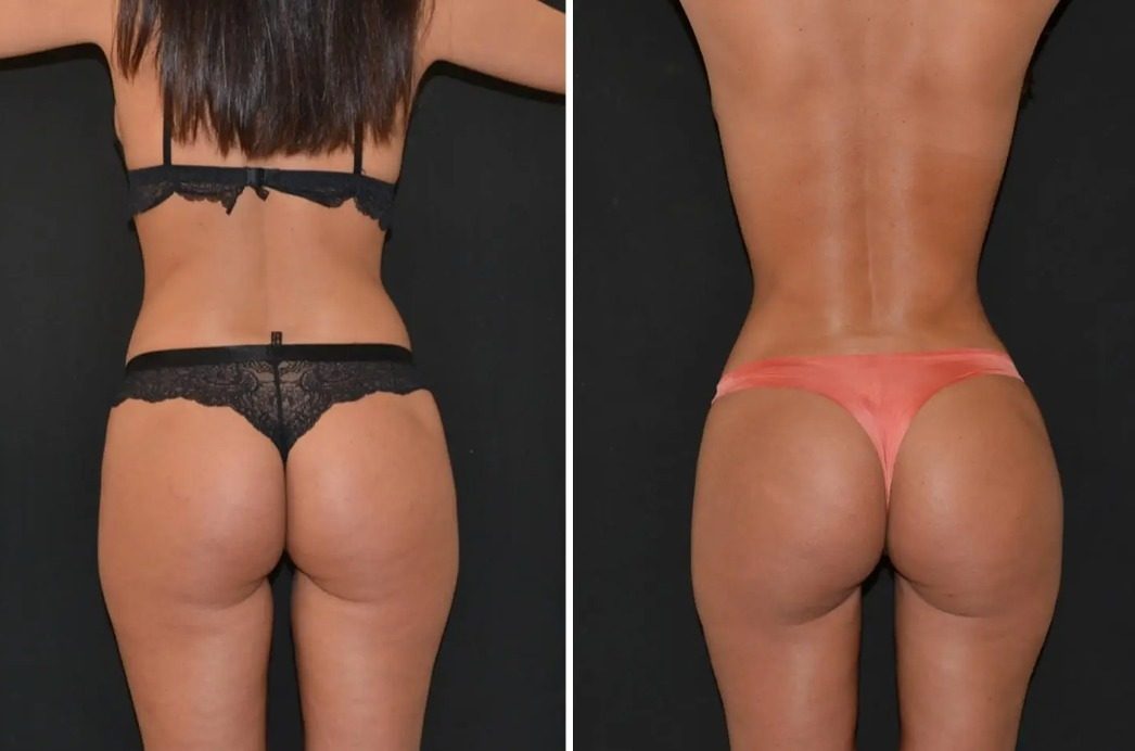 Liposukcja i modelowanie sylwetki, efekt przed i po