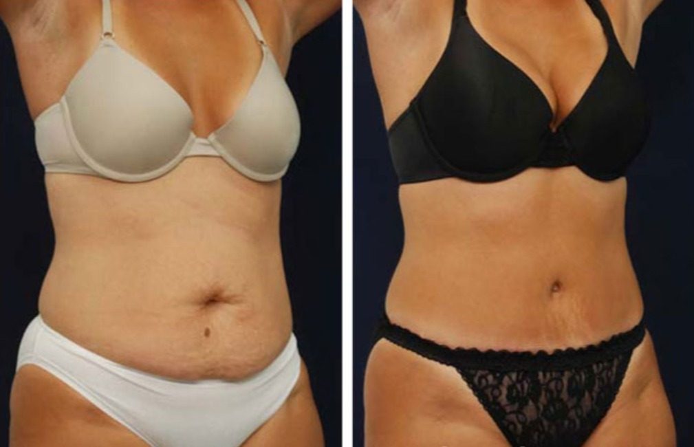 Kontur brzucha po modelowaniu sylwetki, przed i po