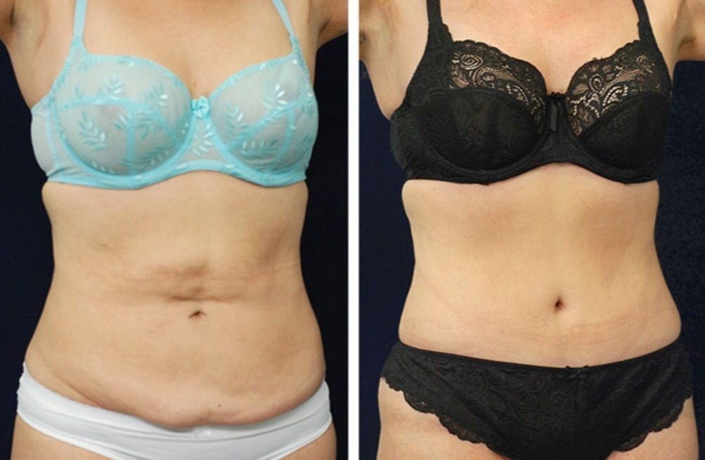 Liposukcja boków, sylwetka przed i po zabiegu