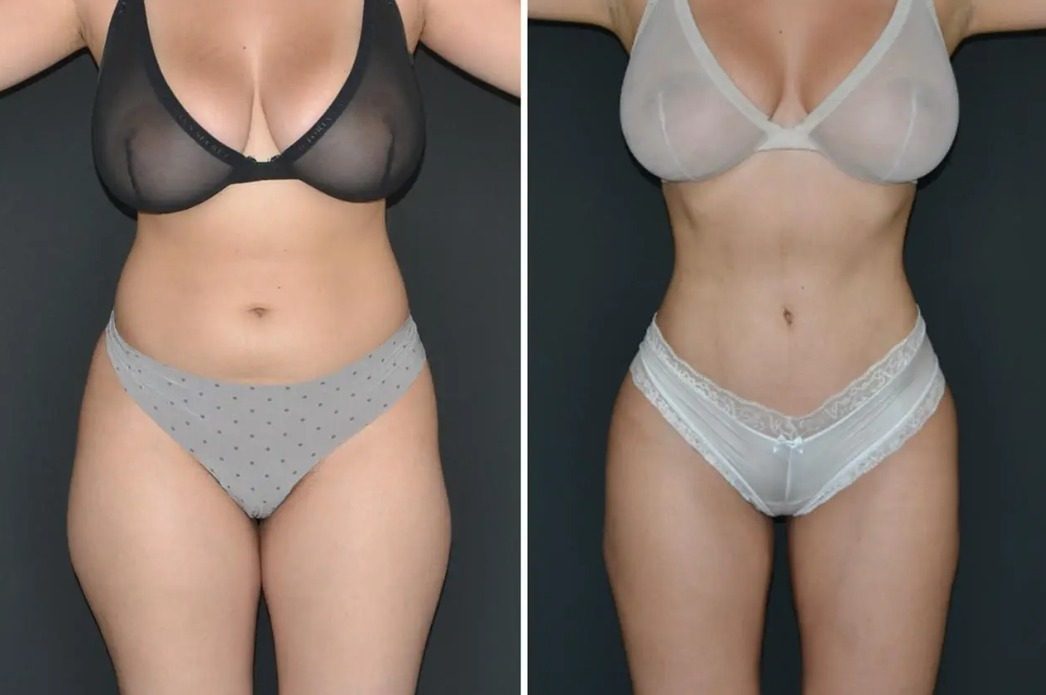 Liposukcja i modelowanie sylwetki, efekt przed i po