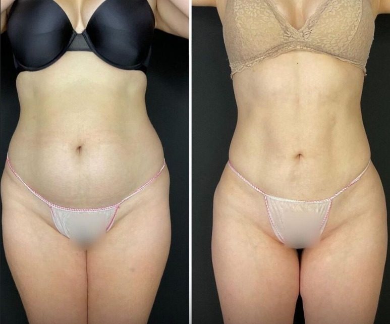Liposukcja i modelowanie sylwetki, efekt przed i po