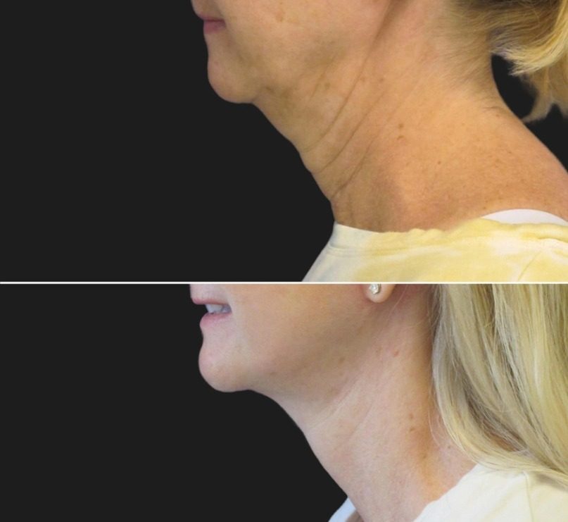 Lifting szyi (neck lift), efekt przed i po