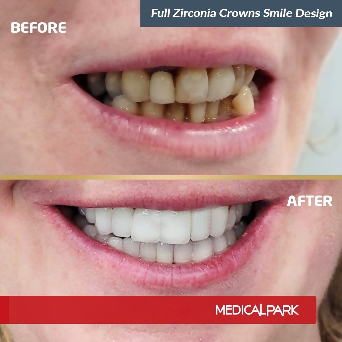 Stomatologia estetyczna, Hollywood Smile, uśmiech przed i po